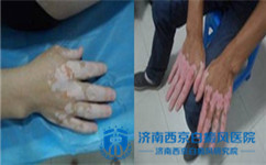 白癜风是什么病