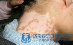 白癜风的并发症有哪些 白癜风的并发症有哪些