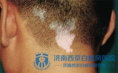 白癜风患者能喝酒吗 白癜风患者能喝酒吗
